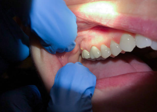 Best Emergency Treatment for Oral Infections in West Fairview, PA